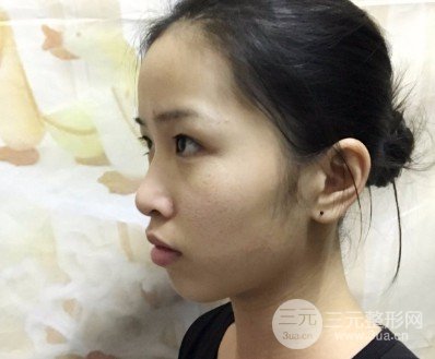 激光美容祛痘前后果对比