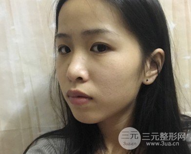 激光美容祛痘前后果对比