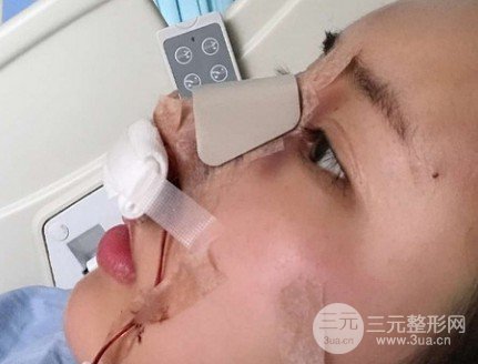 隆鼻手术危险吗