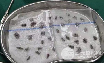 头发如何种植