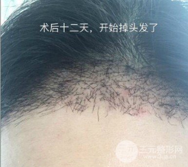 头发如何种植