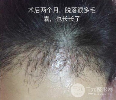 头发如何种植