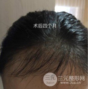 头发如何种植
