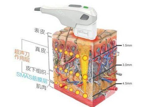 面部轮廓提升