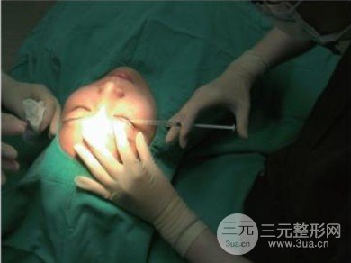 双眼皮手术疼吗