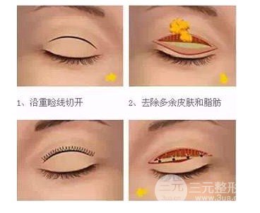 双眼皮手术疼吗