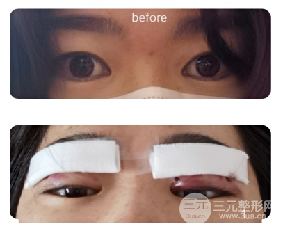 双眼皮手术疼吗