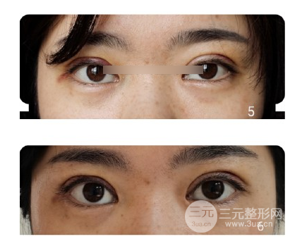 双眼皮手术疼吗