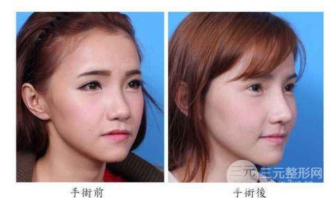 人工骨隆鼻材料