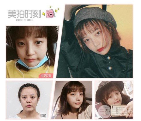 人工骨隆鼻材料