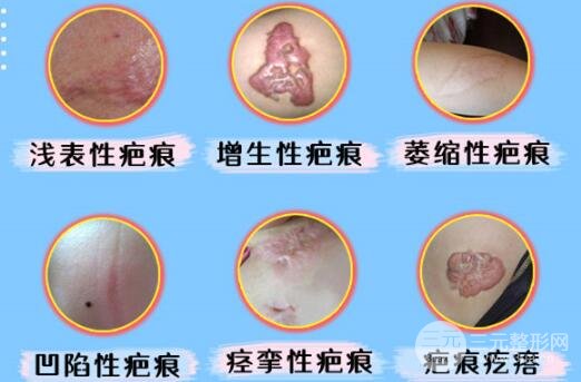 激光去疤痕的图片