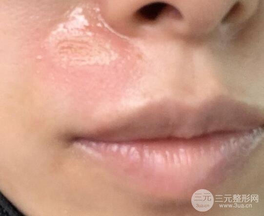 激光去疤痕的图片果
