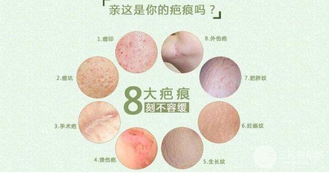 激光祛烟疤前后果图,果真的好吗?真人案例告诉你~