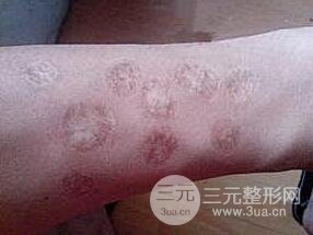 激光去烟疤前后果