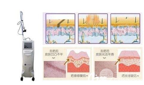 激光去烟疤的注意事项