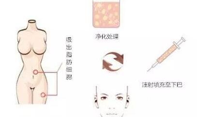 填充自体脂肪后皮肤会变好吗?