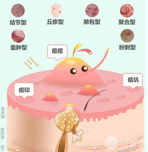 果酸祛痘做几次见