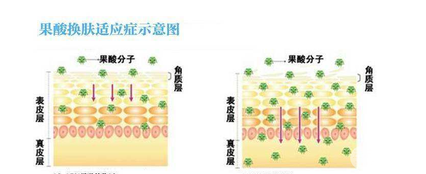 果酸祛痘做几次见
