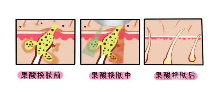 果酸祛痘做几次见