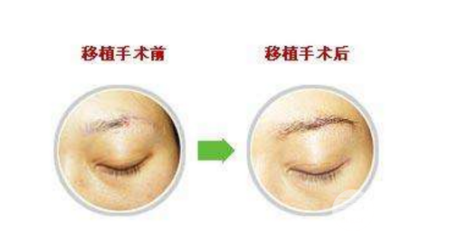 种植眉毛前后图片