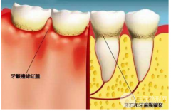 牙结石洗牙能洗掉吗？有什么危害