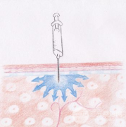 原来注射瘦腿副作用有这三点！集美们快来看！