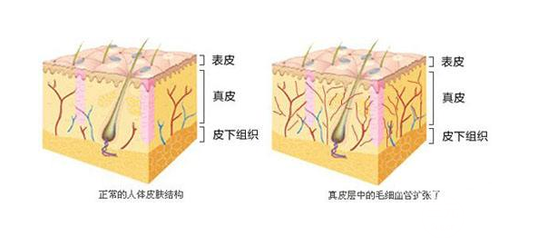 激光去红血丝价格