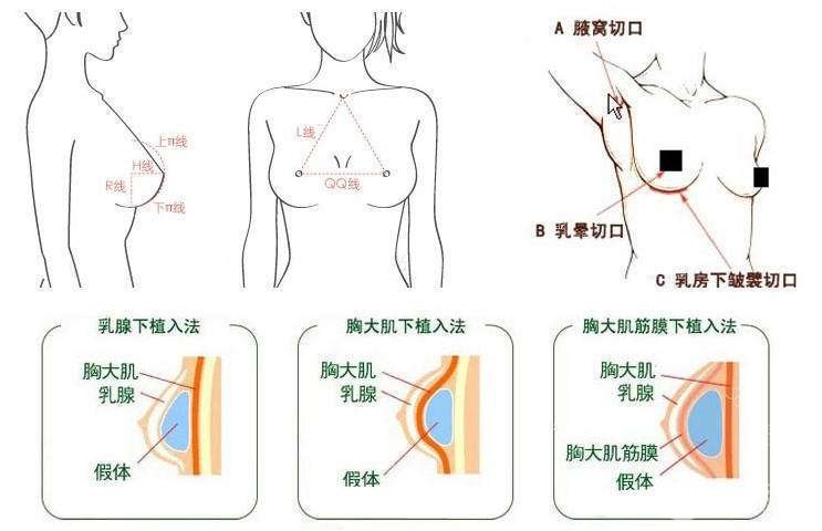 c罩杯多大胸图片欣赏丨胸部整形手术之后需要注意什么？