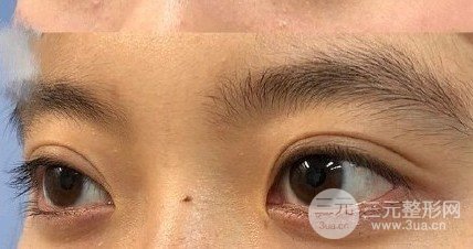 三点定位双眼皮手术记录