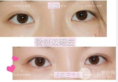 三点定位双眼皮手术记录