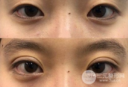 三点定位双眼皮手术记录
