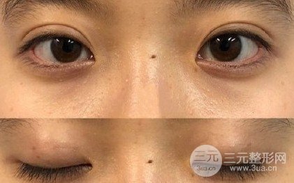 三点定位双眼皮手术记录
