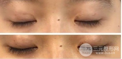 三点定位双眼皮手术记录