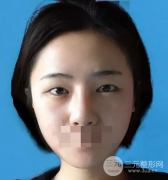 韩式翘睫双眼皮真实感受：朋友说看不到痕迹