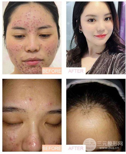 激光缓解痤疮大概多少钱