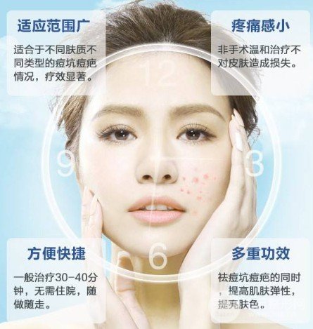 激光缓解痤疮大概多少钱