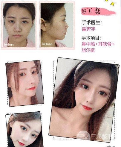 膨体隆鼻果真的那么好