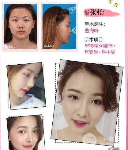 膨体隆鼻果