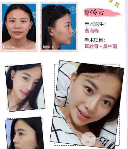 膨体隆鼻果