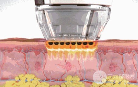光子嫩肤黄褐斑原理