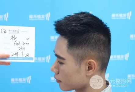 植发2000单位果图