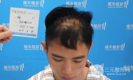 植发2000单位果图