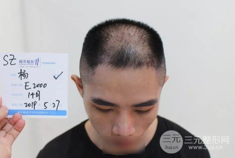 植发2000单位果图