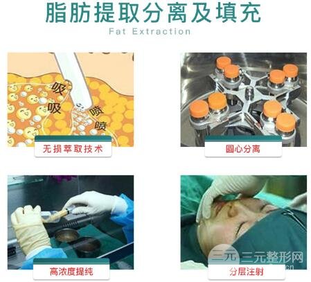 脂肪填充眼窝的特点