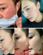 激光去痣痊愈过程图 点痣果分享！匀净了很多！