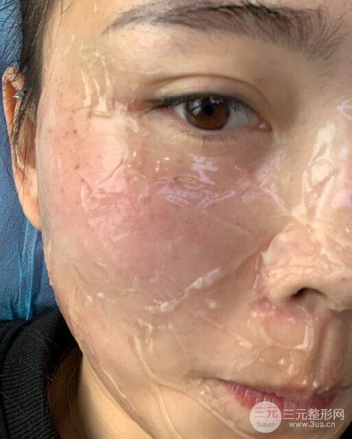 激光去痣痊愈过程图