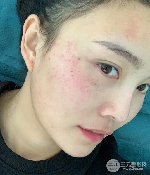 痊愈过程图
