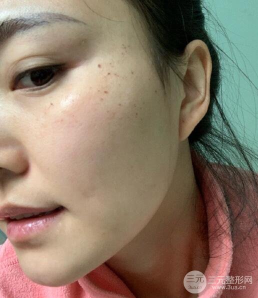 激光去痣痊愈过程图点痣果分享匀净了很多