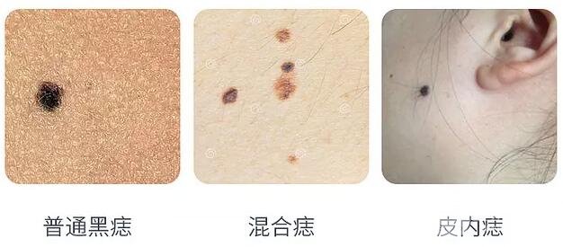 激光点痣