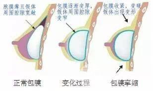丰胸失败的吓人图片
